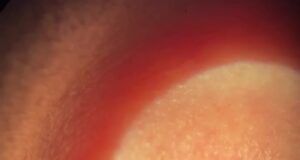 Занесённый комаром червь полгода мигрировал по телу россиянки. В итоге его вытащили из глаза.