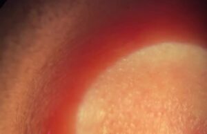 Занесённый комаром червь полгода мигрировал по телу россиянки. В итоге его вытащили из глаза.