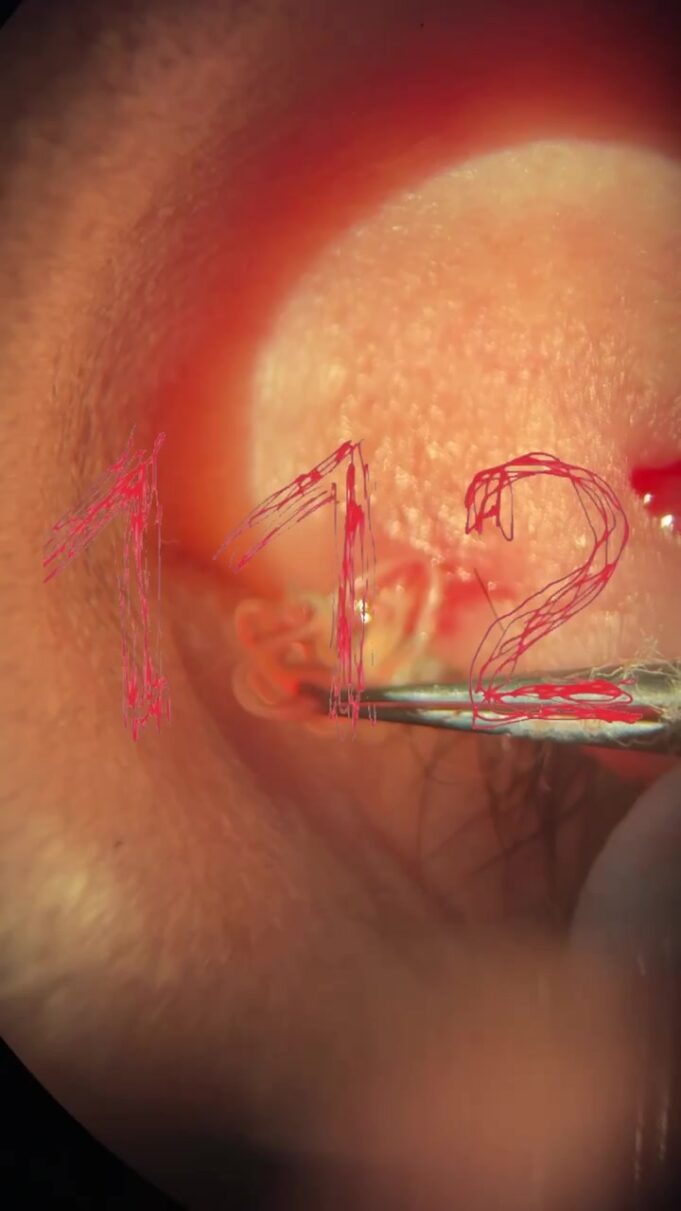 Занесённый комаром червь полгода мигрировал по телу россиянки. В итоге его вытащили из глаза.