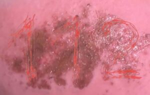 Петербурженка получила химический ожог ягодиц во время поездки в автобусе. Девушка утверждает, что к