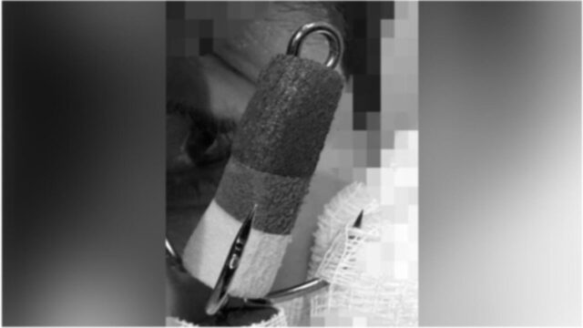 Крючок, который офтальмологи Центр Рошаля достались из глаза мальчика - РИА Новости, 1920, 22.04.2026