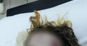 Петербурженке, которую бывший возлюбленный облил кислотой и изрезал ножом, пришлось удалить глаз.