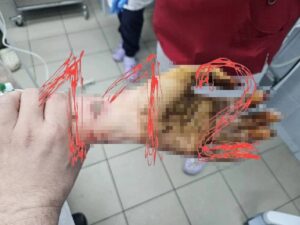 Петербурженке, которую бывший возлюбленный облил кислотой и изрезал ножом, пришлось удалить глаз.