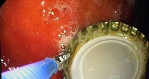 Крышка от бутылки застряла в горле жителя Подмосковья после «сюрприза» дочери. Мужчину спасли врачи.