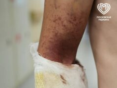 Мужчину, который получил тяжелые ожоги от борщевика, спасли в Москве. Мужчину, который получил тяжелые ожоги от борщевика, спасли в Москве.