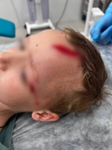 «Собака рвала голову ребенка, а хозяин стоял смотрел»: внук Дарьи Донцовой попал в больницу после на