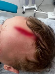 «Собака рвала голову ребенка, а хозяин стоял смотрел»: внук Дарьи Донцовой попал в больницу после на