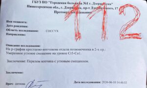Девушка сломала копчик из-за незакрепленной лестницы у банного чана в Нижегородской области.